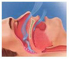 기도가 막힌 코콜이 환자의 모습.  [하나이비인후과병원 제공=연합뉴스]